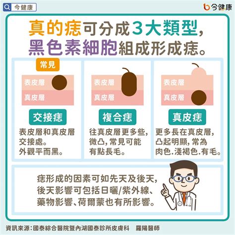 為何會長痣|痣是什麼？一次了解痣原因、就醫時機以及如何改善